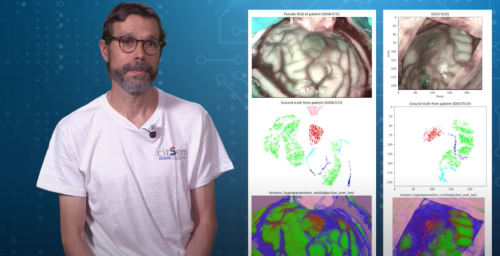 imagen hiperespectral para ayudar a delimitar los bordes de un tumor cerebral, en tiempo real, durante la cirugía